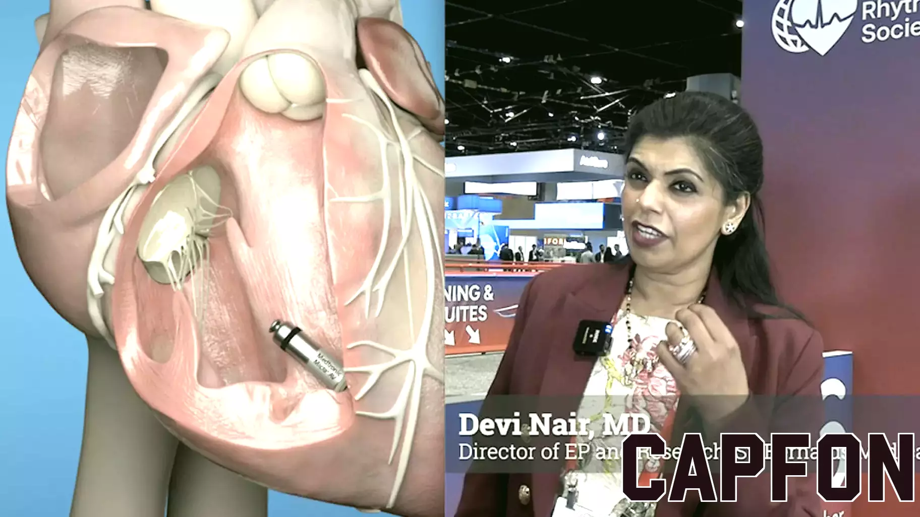 Advances in leadless conduction and Bachmann’s bundle pacing next frontier in physiologic pacing