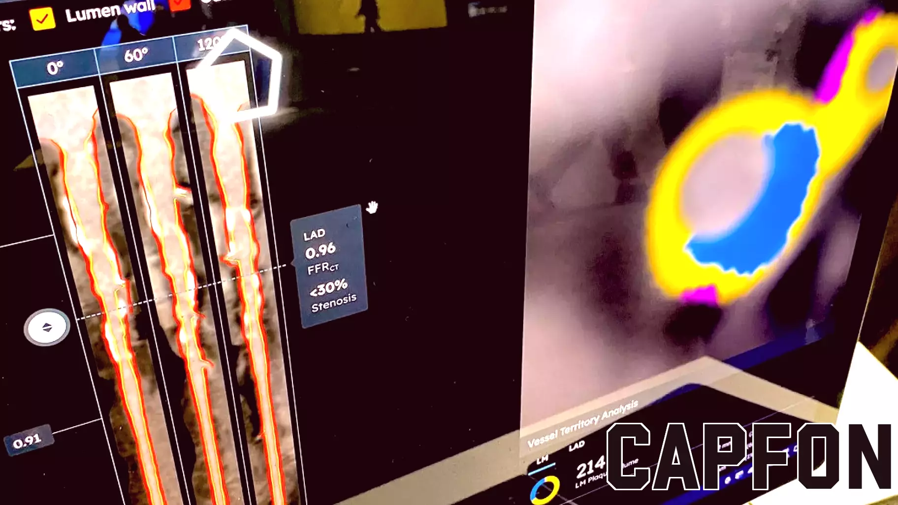 CCTA Implementation Set to Surge with Reimbursement Support