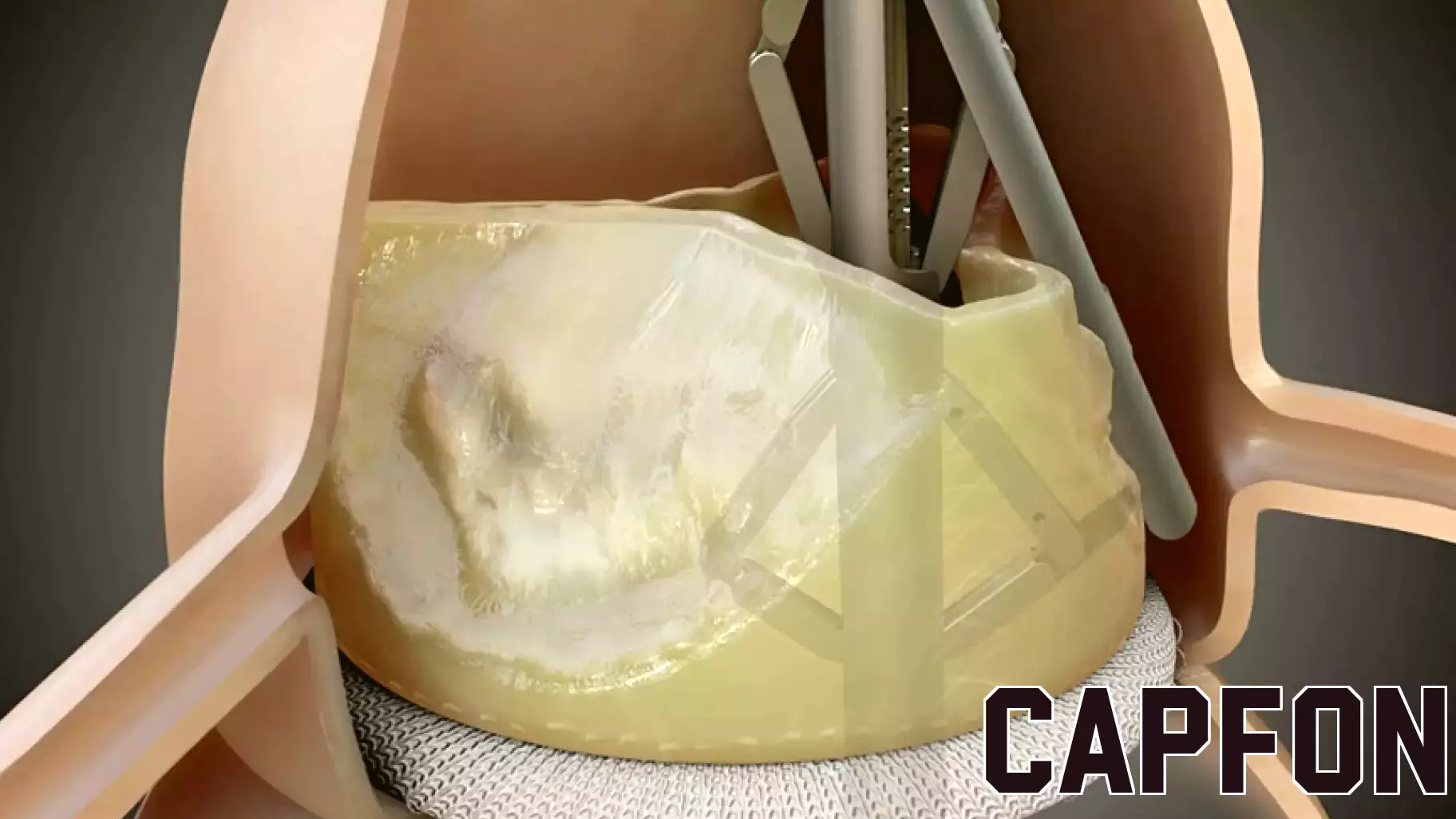 Medtronic invests up to $80M in medtech company Pi-Cardia with a potential buyout on the table
