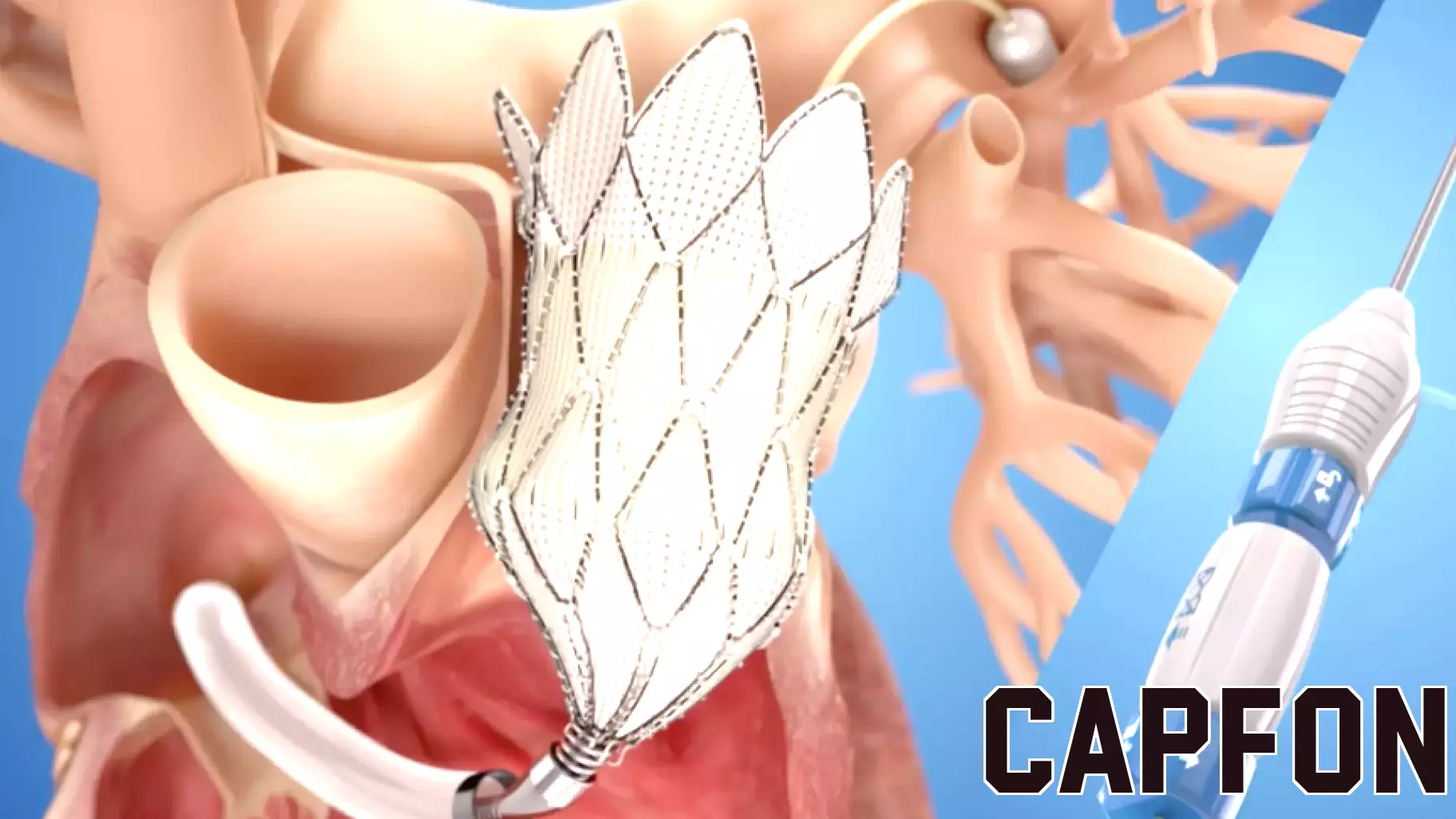 Medtronic recalls heart valve delivery system due to safety risk